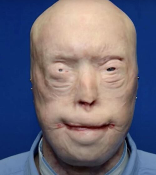 Firefighter suffers third-degree burns – this is him 7 years later